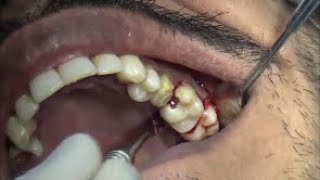 3 molars teeth removal [upl. by Leena635]