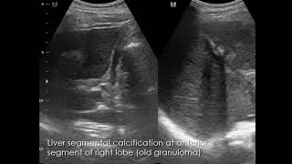 CASE 948 Liver segmental calcification old granuloma [upl. by Airdnua]