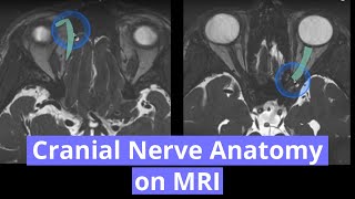 Cranial Nerve Anatomy on MRI [upl. by Irahcaz]