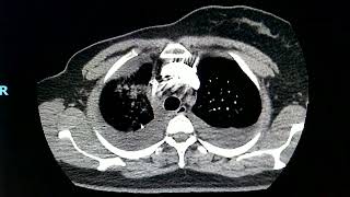 Trombo Embolismo Pulmonar  TEP  Tomografia de TEP  Você sabe como Fazer [upl. by Itoc]