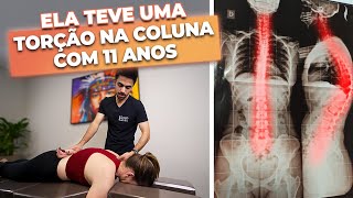 TRATAMENTO DE ESCOLIOSE E HIPERCIFOSE COM QUIROPRAXIA [upl. by Ackerley]