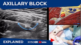 Ultrasound Guided Axillary Brachial Plexus Block NYSORA Regional Anesthesia [upl. by Magavern756]