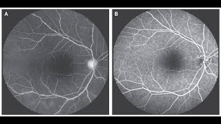 Vaskulitis der Retina bei Takayasu Arteriitis [upl. by Sallyanne]