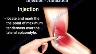 Tennis Elbow Lateral Epicondylitis Injection [upl. by Curson]