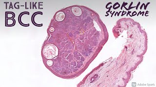 Taglike basal cell carcinoma in Gorlin syndrome basal cell nevus syndrome [upl. by Launce]