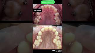 Crowded teeth how tooth movement occurs dentist orthodontist braces procedure Drswetakaushik [upl. by Storer]