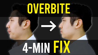 Overbite amp Overjet Fix｜Facial Asymmetry Correction｜Corrective Exercises [upl. by Eerrehc]