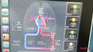 Cardiac Output monitoring machine Basic Terms  Anesthesiology  Stroke Volume  SVRI  CVP [upl. by Mariquilla]