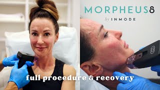 Morpheus 8 Radiofrequency  Microneedling Treatment Before amp After Full procedure amp recovery [upl. by Nylodnarb332]