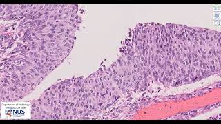 Renal pelvis Invasive urothelial carcinoma Microscopy  Talking slide [upl. by Amaerd919]