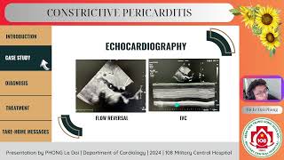 Constrictive pericarditis [upl. by Bamford]