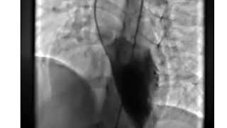 LV Angiogram Profiling Perimembranous VSD [upl. by Aivirt]