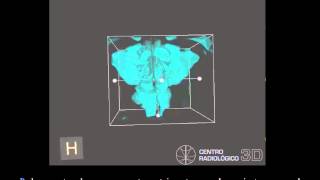 Examen de vias aereas usando CBCT Cone beam Carestream C9300Manuel Ruiz P mov [upl. by Renae]