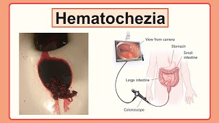 hematochezia [upl. by Shanan]