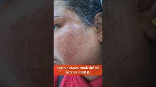 Steroid cream आपके चेहरे को ख़राब कर सकती है  steroidssideeffects betnovate betnovatencream [upl. by Schramke294]