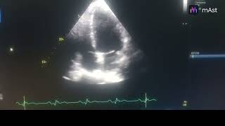 HYPOKINESIA OF INFEROLATERAL  INFERIOR WALL AND ANTEROLATERAL WALL MODERATE LV [upl. by Ree]