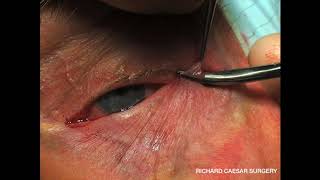 Lower Eyelid Ectropion  A Practical Approach [upl. by Schuyler]