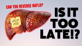 NAFLD How to Treat and Reverse NonAlcoholic Fatty Liver Disease [upl. by Infeld360]