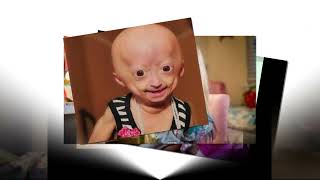 Youtuber Adalia Rose Texas star dies at 15 from rare medical condition [upl. by Ailgna]