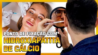 Ponto de fixação com HIDROXIAPATITA DE CÁLCIO [upl. by Nilyaj]