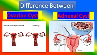 Difference Between Ovarian cyst and Adnexal Cyst [upl. by Anidal177]