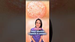 Fungal infection  kaise prevent kare  dermatologist [upl. by Harris]