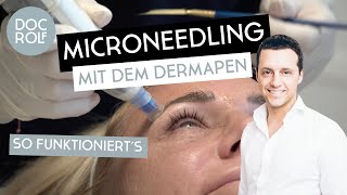 MEDIZINISCHES MICRONEEDLING mit dem DERMAPEN® – Dr Rolf Bartsch [upl. by Tomkins18]