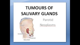 ENT Tumors of Salivary Glands Parotid Neoplasms Benign Malignant Pleomorphic Warthin Cylindroma [upl. by Yajet223]