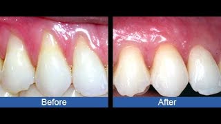 TREAT RECEDING GUMS NATURALLY AT HOME WITHOUT VISITING THE DENTIST [upl. by Auhsaj]