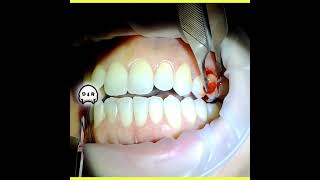 Peripheral Ossifying Fibroma Excision on Buccal Gingiva [upl. by Takara361]