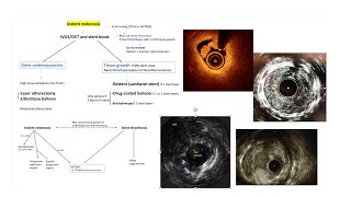 DES instent restenosis mechanisms and interventional management Elias Hanna [upl. by Catto515]