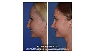 Rhinoplasty  Fixing a Hanging Columella  Do I have a Hanging Columella [upl. by Micaela119]