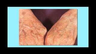 Actinic Keratosis Precancerous Skin Cancer [upl. by Yraunaj]