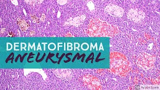 Dermatofibroma Aneurysmal Type Aneurysmal Benign Fibrous Histiocytoma pathology dermpath [upl. by Akyre]