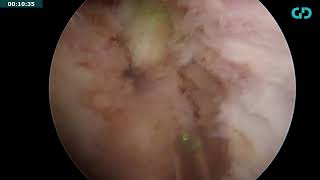 Holmium laser enucleation of the prostate step1 [upl. by Taub]