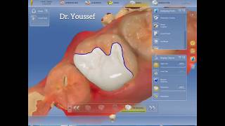 Onlay indirect restoration  cerec CadCam [upl. by Guadalupe]