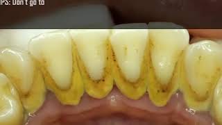 Ultimate Teeth Cleaning Treatment  Easy Tips for a Brighter Smile [upl. by Uziel]