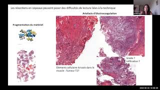 Tumeur de vessie de lendoscope au microscope apport de la résection monobloc [upl. by Naik]