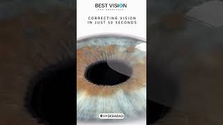 SMILE PRO Vision Correction  Achieve Clear Natural Vision Without Glasses lasereyesurgery vision [upl. by Ibson807]