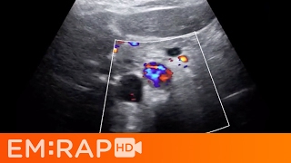 Ultrasound of Aortic Dissection [upl. by Pooley]