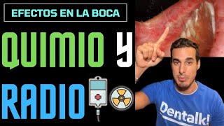 Así afecta a la BOCA la QUIMIOTERAPIA y RADIOTERAPIA ☢️ Efectos secundarios [upl. by Jenda831]