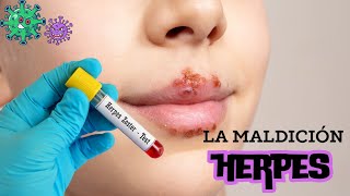 Herpes y cómo se propaga Tratamiento y prevención herpeszoster enfermedades síntomas [upl. by Yenar]