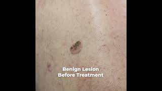 Benign Lesion Treatment Fotona Erbium Laser [upl. by Gun]