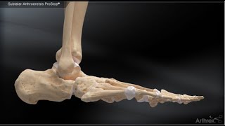 Subtalar Arthroereisis ProStop® [upl. by Nemzaj846]