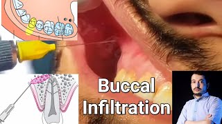 Local Anesthesia Buccal Infiltration Technique Maxillary Anesthesia Techniques dentistry [upl. by Einnoj]