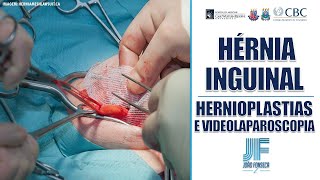 HÉRNIAS ABDOMINAIS Parte 9 INGUINAL HERNIOPLASTIAS E VIDEO 👨🏽‍⚕️🚑 Joao Fonseca Cir Geral [upl. by Ogilvie533]