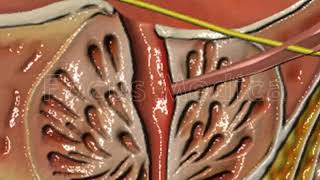 Dihydrotestosterone in BPH  Animated Atlas of BPH and OAB [upl. by Yedrahs]