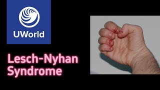 LeschNyhan Syndrome amp purine salvage pathway USMLE Step 1 UWorld Questions Nervous System [upl. by Stillman]