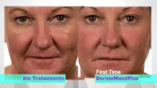 derma wand plus resultados [upl. by Kutchins307]