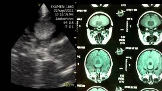 VSCAN Intraoperative quotpocketquot ultrasound Cerebellar Vermis Medulloblastoma [upl. by Alodee]